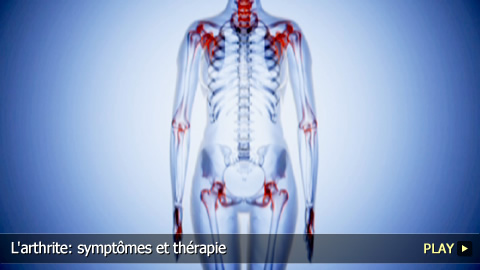 L'arthrite: symptômes et thérapie