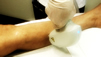 Laser Hair Removal Method