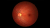 Diabetes Eye Exam: Test Against Early Blindness