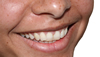 Fluoride in Tap Water: Good or Bad? Dental Health Tips