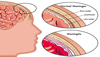 Meningitis: Signs, Symptoms, Risk Factors