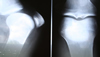 How To Keep Your Bones Healthy